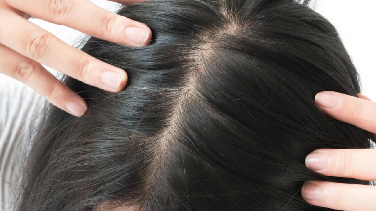 Kadınlarda Saç Dökülmesine Neden Olan Faktörler
